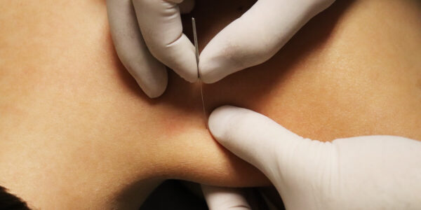 Mobile dry needling in Wollongong service photo